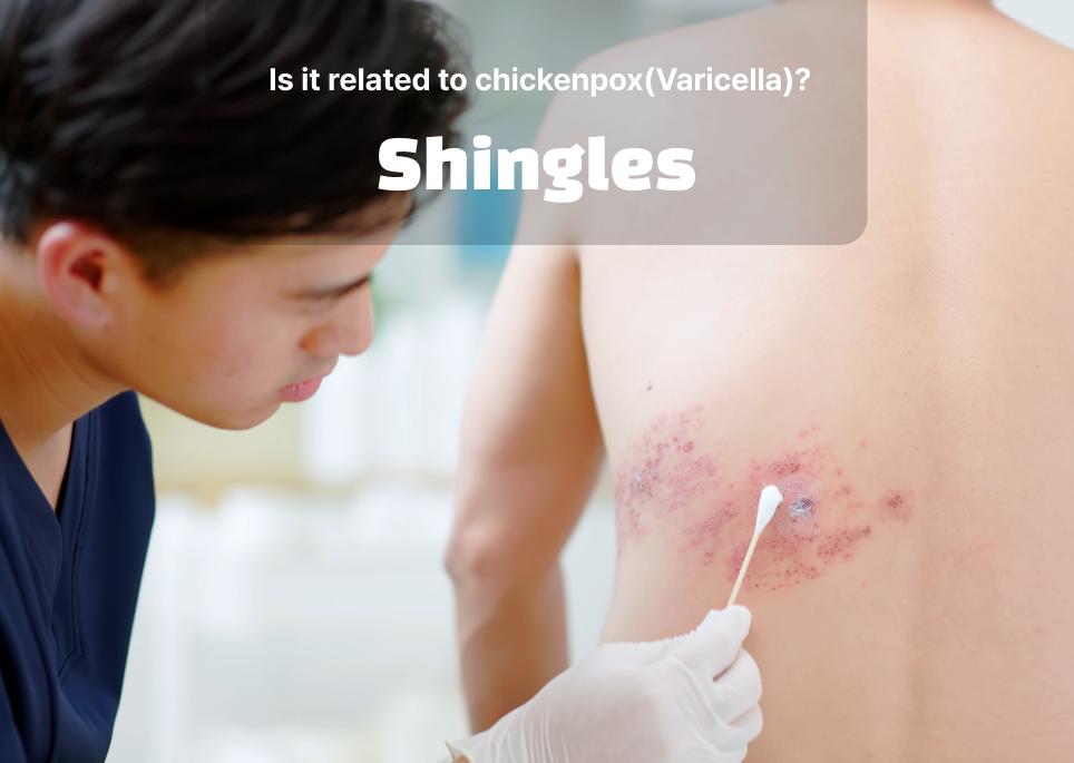 Shingles (Herpes Zoster)! Is it related to chickenpox (Varicella)?